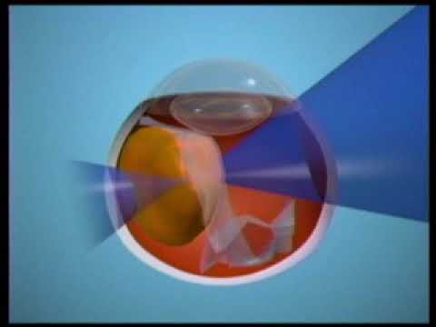 Wayne Lytle - Visualization of Simulated Treatment of an Ocular Tumor