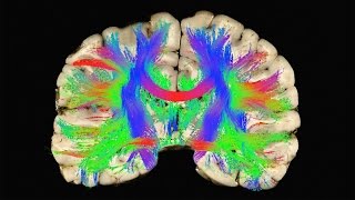 Why helmets don't prevent concussions -- and what might | David Camarillo