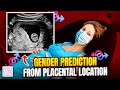 Can You Predict Your Baby S Sex With The Ramzi Theory Placenta Location