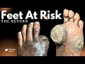 Feet At Risk: The Return