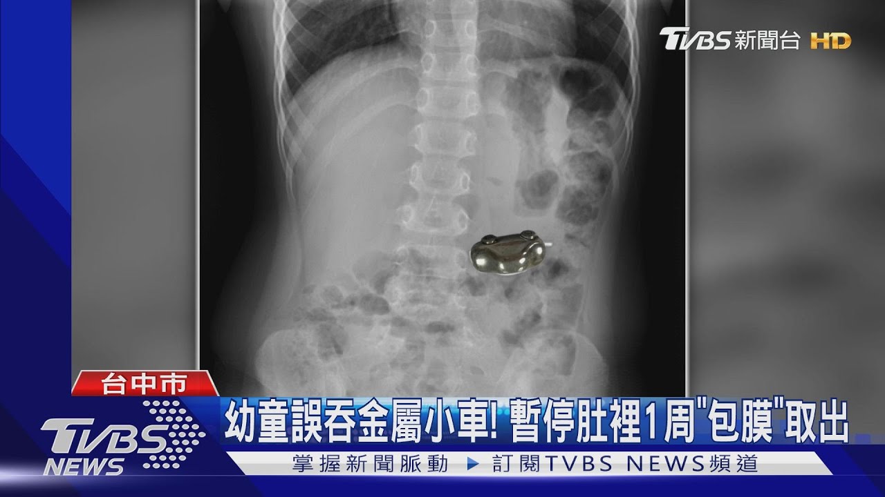 幼童誤吞金屬小車！　暫停肚裡1周「包膜」取出