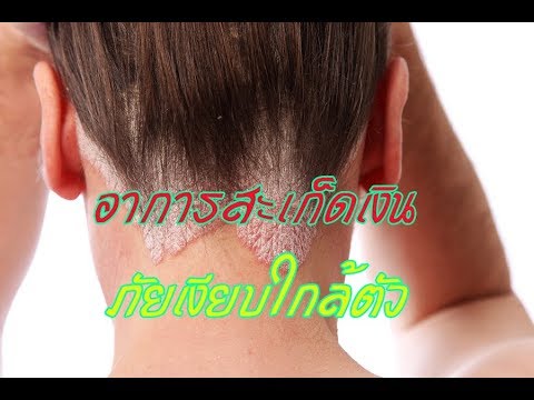 ครีม psorimilk การแสดงความคิดเห็นเป็นโรคสะเก็ดเงิน น้ำผลไม้ Celandine สำหรับการรักษาโรคสะเก็ดเงิน