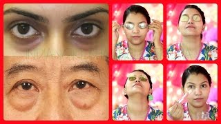 Best 5 Remedies for Puffy eyes/dark circles/eye bags/swollen eyelids (with demo)
