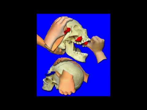 SOT CAT I Cranial Right Frontal External Step 2