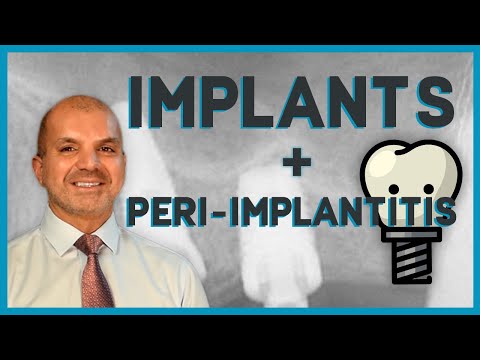 Learn Implants In 10 Minutes - What Every Dentist Should Know
