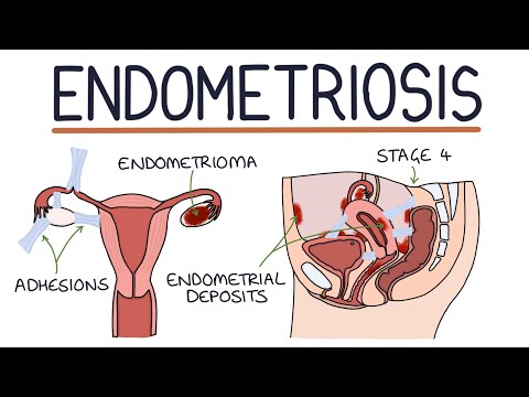 Understanding Endometriosis