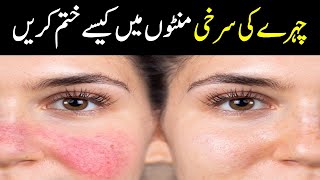How to Remove Face Redness Naturally Urdu Hindi || Face Redness Treatment | Face Redness Remove Tips