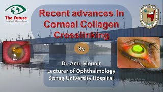 The recent advances in corneal collagen cross-linking (CXL)