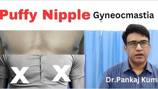 Puffy nipples treatment| Grade 1 Gynecomastia treatment| Gynecomastia treatment in Ranchi #gyno