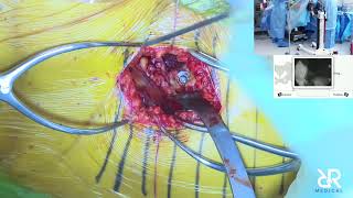 Dr. Stefan Kreuzer performs Total Hip Arthroplasty Using IOT Purist Table
