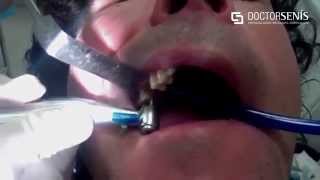 Implantes dentales en 3 minutos