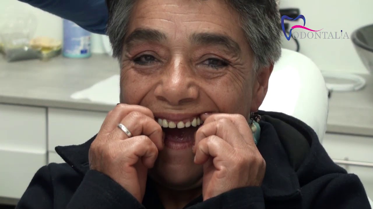 PROTESIS REMOVIBLE - Odontalia Ec - Pa10