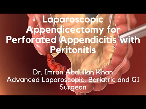 Laparoscopic Appendicectomy for perforated Appendicitis with peritonitis | Dr. Imran Abdullah Khan