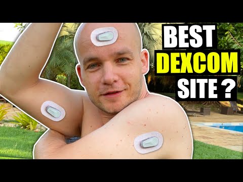 7 Best Sites for Dexcom G6 Sensor Placement