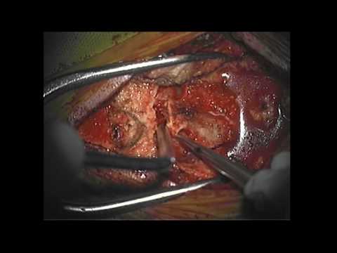 Resection of the Fourth Ventricle Tumor - Craniotomy