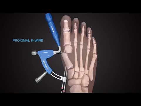 Minimally-Invasive Bunion Correction Surgery | Kansas City Direct Care Podiatrist