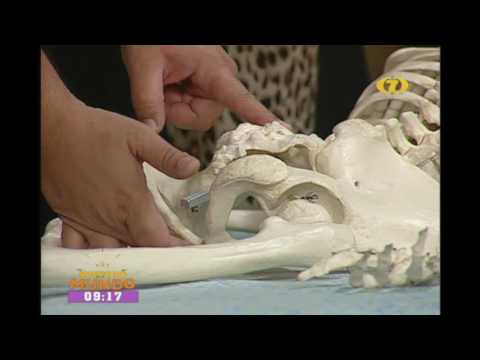 El costo y el tipo de prótesis para la cadera La hernia intervertebral en la zona lumbar de vídeo cirugía