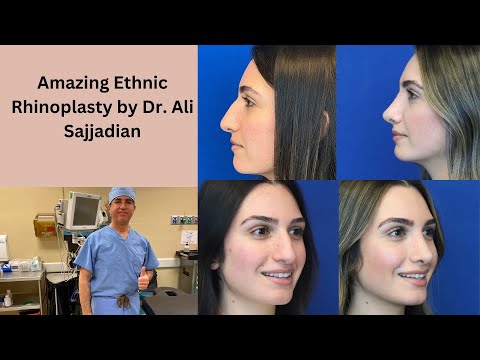 Amazing Ethnic Rhinoplasty - Middle Eastern by Dr. Ali Sajjadian! | before + after