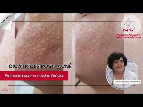 Cómo eliminar CICATRICES de ACNÉ con Ácido Pirúvico | Protocolo Paso a Paso