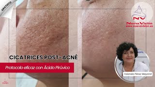 Cómo eliminar CICATRICES de ACNÉ con Ácido Pirúvico | Protocolo Paso a Paso