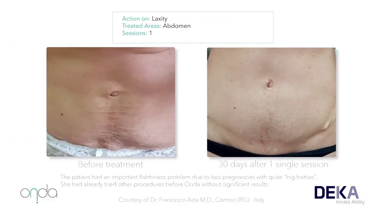 Onda Coolwaves Prima e Dopo