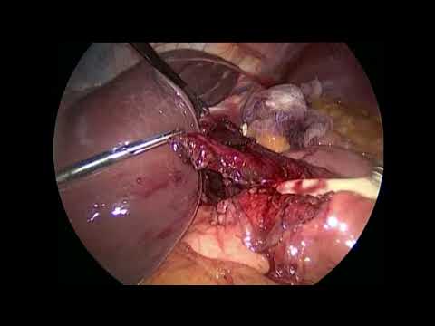 Laparoscopic Resection of an Epiphrenic Diverticulum