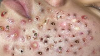 Loan Nguyen Acne Treatment 11m