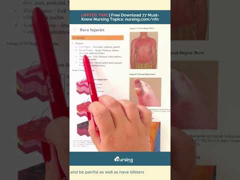 Understanding Burn Injuries for Nursing Students 🩺✨