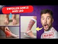 Say Goodbye to Swollen Legs and Feet! #healthjourney