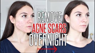 How To Get Rid Of ACNE SCARS OVERNIGHT !!