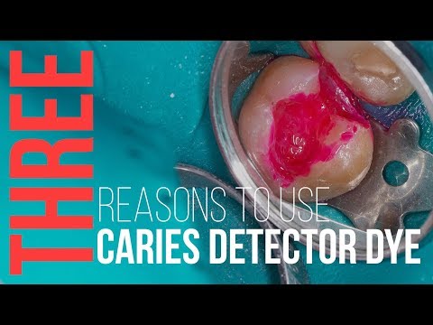 3 Reasons to Use Caries Detector Dye