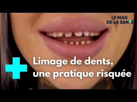 “Shark Teeth,” the Influencer Trend That Worries Doctors - Le Magazine de la Santé