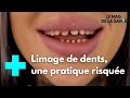 “Dents de requin”, la tendance des influenceurs qui inquiète les médecins - Le Magazine de la Santé