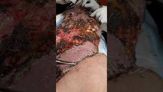 Picking scabs explained,  Pickers Delight