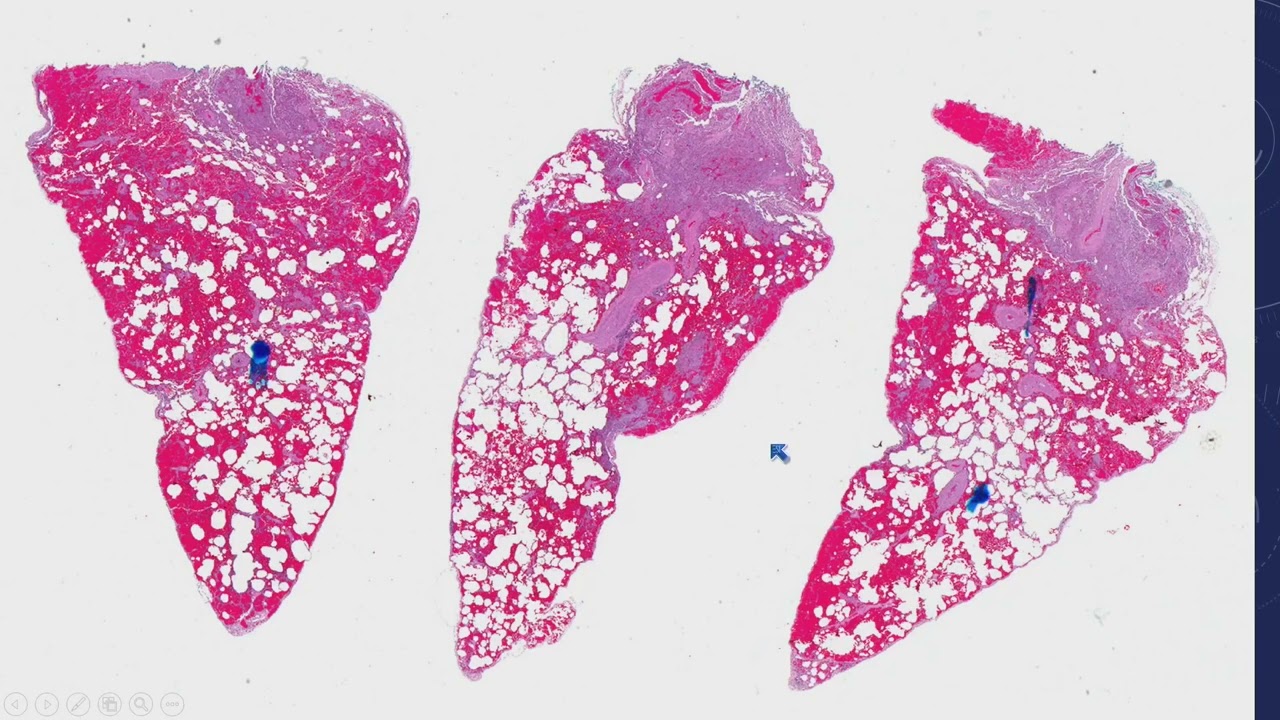 2023 Classic Lectures in Pathology: What You Need to Know: Lung Pathology - A CME Teaching Activity
