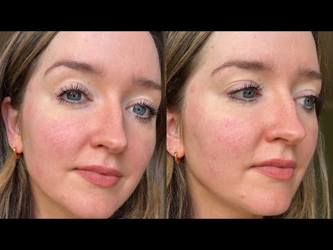 Ultimate guide to rosacea - part 3 of 4: treatment steps you can access from home