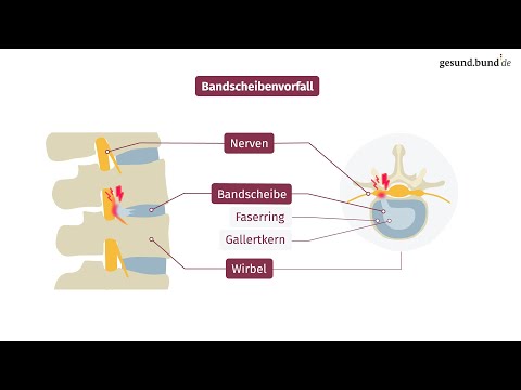 What is a herniated disc?