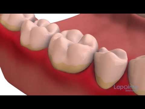 Dental plaque - Lapointe dental centres