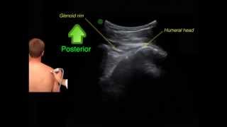 Point of care ultrasound in shoulder dislocations
