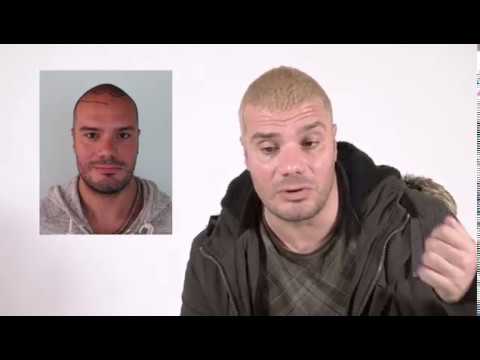 Lorenzo Renzi trapianto capelli turchia