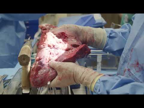 An Innovative Double-Lung Transplant Using Breast Implants