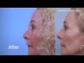 FaceLift Fat Graft - PLASTIC SURGERY Post-Op