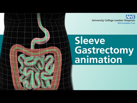 Sleeve Gastrectomy animation