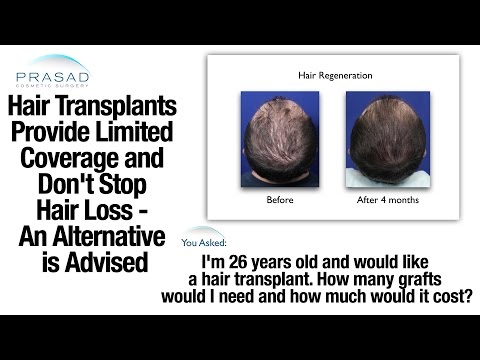 Hair Transplants Do Not Stop Hair Loss,  Treatment Can without Surgery