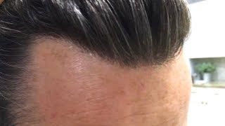 UP CLOSE on my Hairline, Hair Replacement or Hair System