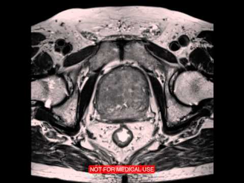Einige Verwendung für Prostatamassager Adenom Kerzen vitaprost