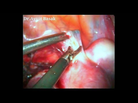 Totale laparoskopische Hysterektomie und bilaterale Salpingo-Oophorektomie bei Uterus myomatosus