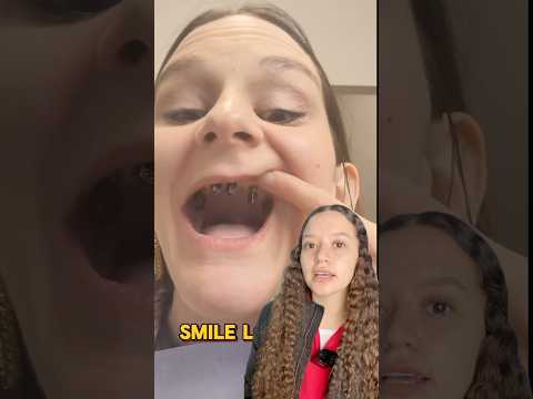 Dental implants with prosthetics #dentistry #dentalprosthetics #teeth #dentalscrew