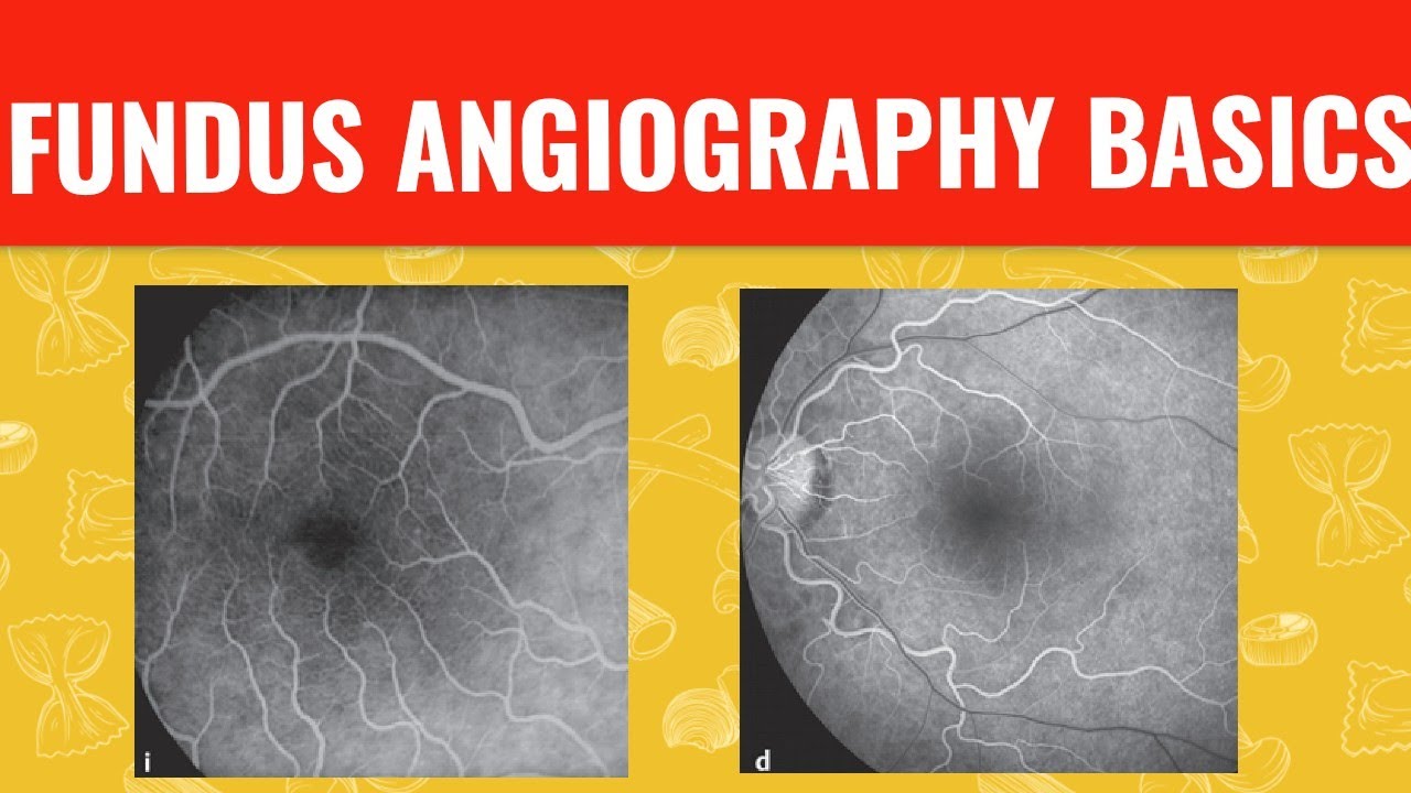 Understanding LASIK Surgery