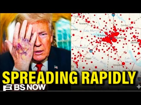 “US Measles Outbreak 2025: Why Red States Are Suffering & Vaccines Matter”